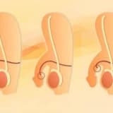 Çocuklarda HİPOSPADİAS