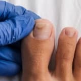 Tırnak Boşalması (Onikoliz) Nedir? Neden Olur ve Nasıl Çözülür? 🦶✨
