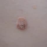 HUMAN PAPİLLOMA VİRÜS YANİ HPV NEDİR? HPV AŞILARI İLE İLGİLİ BİLGİLER