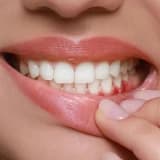 Dişleriniz Neden Bir Anda Hassaslaşmaya Başladı?