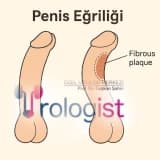 PENİS EĞRİLİĞİ nedir? Cinsel hayatı etkiler mi? Tanı ve tedavisi mümkün mü?