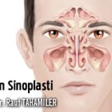 Balon Sinoplasti