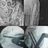 OSTEOPOROZA ( KEMİK ERİMESİ) BAĞLI KALÇA KIRIKLARI