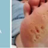 Siğil Tedavisi Nasıl Olur