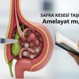 Safra Kesesi Taşı ve Polipleri: Ameliyat mı, Takip mi?