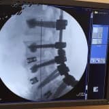 Vidalı Omurga Ameliyatı nedir? Spinal Enstrümantasyon ve Spinal Füzyon Nedir?
