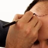 Follicular Unit Extraction - Fue Saç Ekiminde Alternatif Bir Yaklaşım