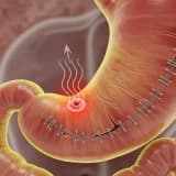 Tüp Mide Ameliyatı Sonrası Reflü Neden Olur ve Nasıl Tedavi Edilir?