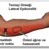 TENİSCİ DİRSEĞİ