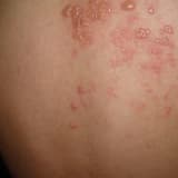 HERPES ZOSTER, ZONA VEYA HALK DİLİNDE GECE YANIĞI