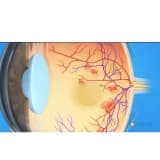 DİYABETİN GÖZE ETKİLERİ