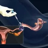 İntrauterin inseminasyon (aşılama tedavisi)