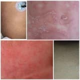 Miliaria yani İSİLİK