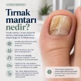 Her kalınlaşmış tırnak mantar değildir!