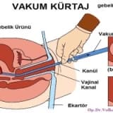 Kürtaj Nasıl Yapılır?