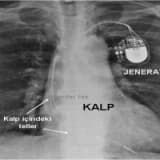 Kalp pilleri hakkında 1, kalp pili hastalarına öneriler