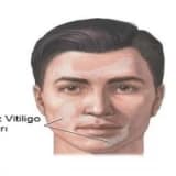 Vitiligo ( Ala Hastalığı )