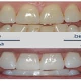 Diş Beyazlatma ( Bleaching ) Nedir ?