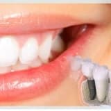 DİŞ EKSİKLİĞİ ve İMPLANT TEDAVİSİ