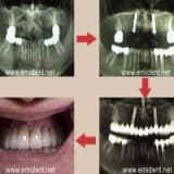 İmplant ''sorular ve cevaplar''