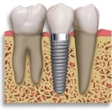 Dental ( Dişle ilgili) İmplantlar