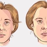 YÜZ FELCİ (PERİFERİK FASİYAL PARALİZİ)