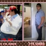OBEZİTE ve TEDAVİSİ