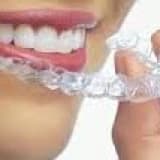 Invisalign İle Tedavi