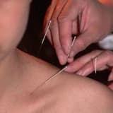 AKUPUNKTUR İLE ALLERJİK NEZLE (RİNİT) VE ASTIM TEDAVİSİ