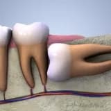 YİRMİ YAŞ DİŞİ VE KLİNİK ÖNEMİ