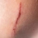 Yara İzi Tedavisi (Skar Revizyonu)