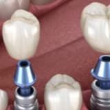 İMPLANT DESTEKLİ PROTEZ