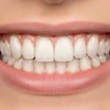 Estetik Diş Kaplamaları
