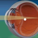Retina Neresidir?