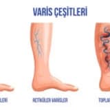Varis Hastalığının Komplikasyonları Nelerdir??