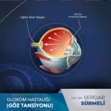 Glokom Hastalığı (Göz Tansiyonu)
