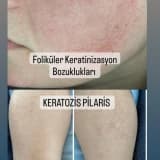 KERATOZİS PİLARİS
