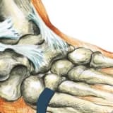 Ayak bileği burkulması nedir?