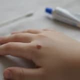 Çocuklarda Siğil Neden Olur ve Nasıl Tedavi Edilir?