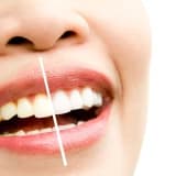 Diş Beyazlatma (Bleaching) Zararlı Mıdır ve Ne Sıklıkla Yapılmalıdır?