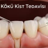 Diş Kökü Kist Tedavisi: Neden Önemlidir ve Nasıl Planlanır?