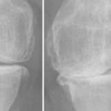 Diz Protezi Ameliyatı: Hastalar İçin Kapsamlı Bilgilendirme