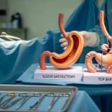 Tüp Mide Ameliyatı Tekrar mı Yapılır Yoksa Gastrik Bypass’a mı Çevrilir?