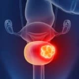 Mesane Kanserinde Olası Nedenler Ve Koruma