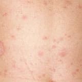 Pityriasis rosea: a natural history of pediatric cases in the Central Anatolia Region of Turkey