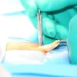 Kasık Fıtığı Cerrahisi