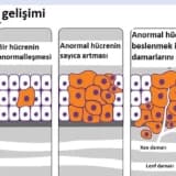 KANSER NEDİR