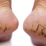 🦶 Nasır Nasıl Geçer? Aldırıyorum Ama Yine Çıkıyor! Nasırın Asıl Nedeni Ne?