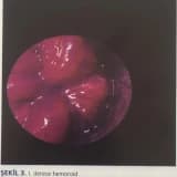 HEMOROİDAL HASTALIK