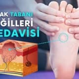 SİĞİL NEDİR ? SİĞİL TEDAVİSİ NASIL OLUR ?